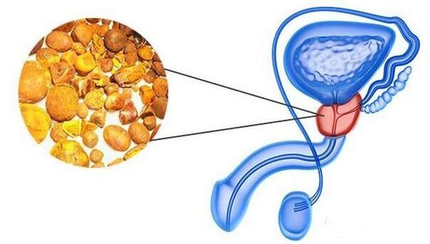 Calcine dans la glande de la prostate