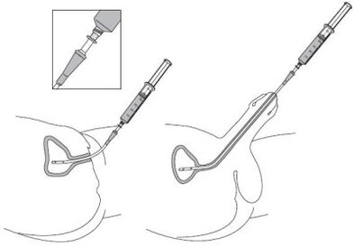 Instillation d'une solution médicamenteuse à l'urètre