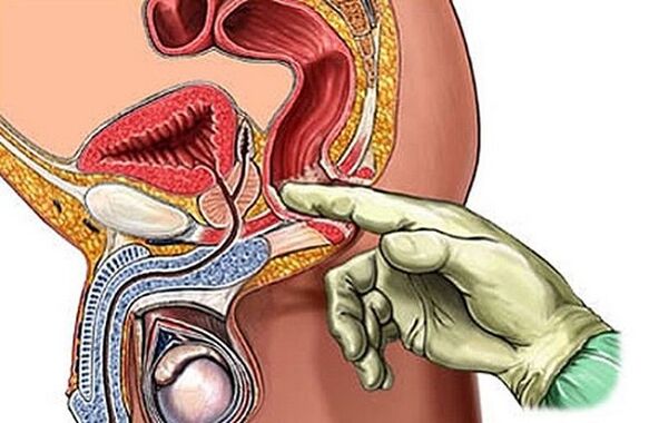 Le massage de la prostate comme moyen de traiter la prostatite