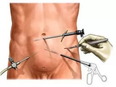 traitement chirurgical de la prostatite chronique