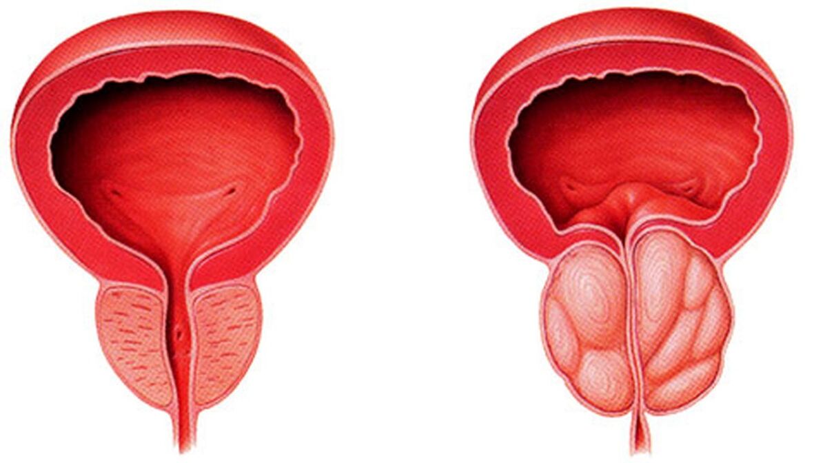 prostate saine et enflammée avec prostatite